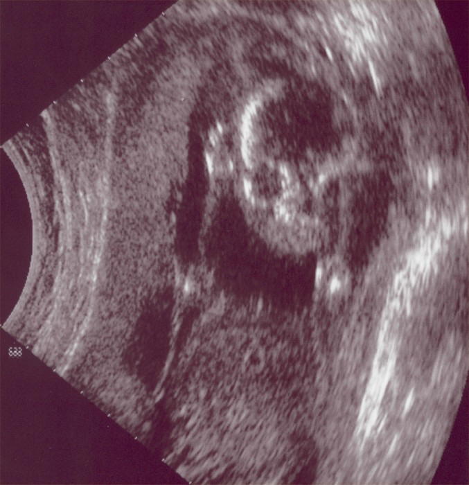 2004 11 23 Ultrasound1 - Face
