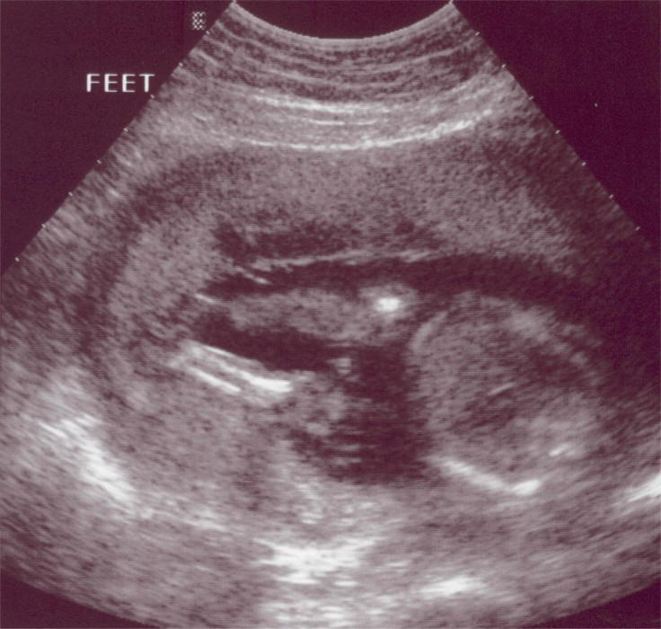 2004 11 23 Ultrasound4 - Feet