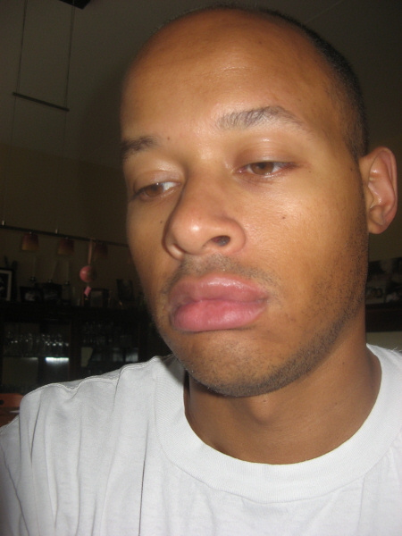 2007 08 21 In August, J had the worst run of luck... got shingles and then scraped himself up pretty badly falling off his bike. The next day, he came home all swollen up. Turns out a bee had flown into his mouth and stung him inside his lip! Ouch.